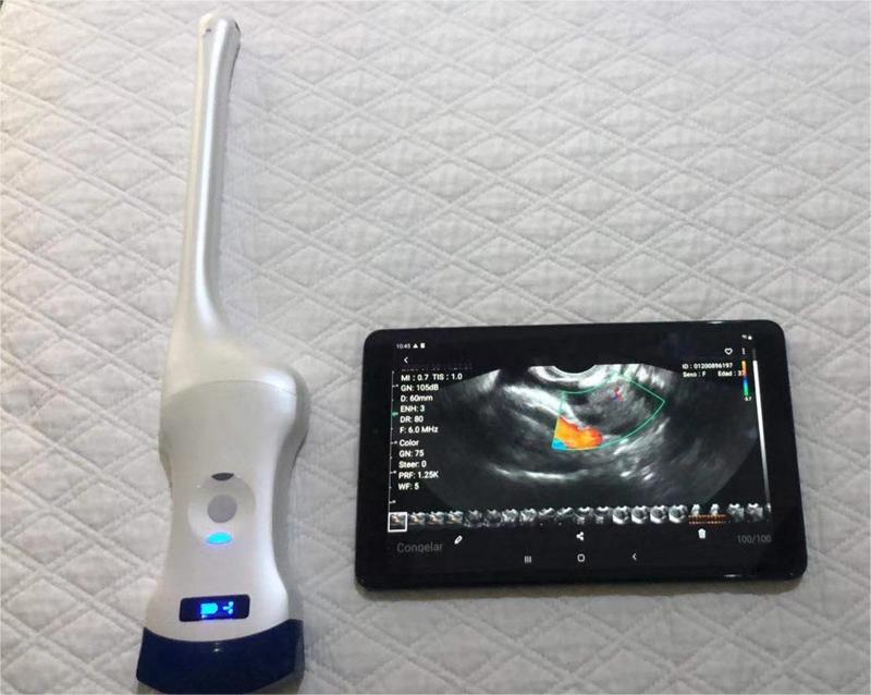 intracavitary ultrasound probe imaging
