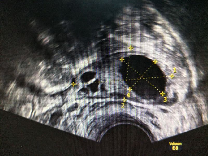 ultrasound transvaginal 6 minggu